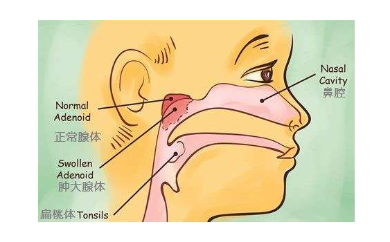 6岁宝宝腺样体肥大终痊愈只有为人父母才能体会